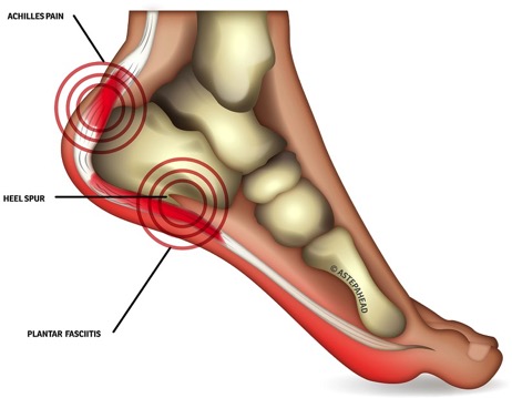 Achilles Tendon Bursitis - Bone, Joint, and Muscle Disorders - Merck  Manuals Consumer Version